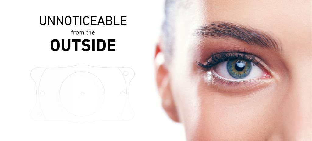 The Aesthetic Advantages of Phakic Lenses Unnoticeable from the Outside