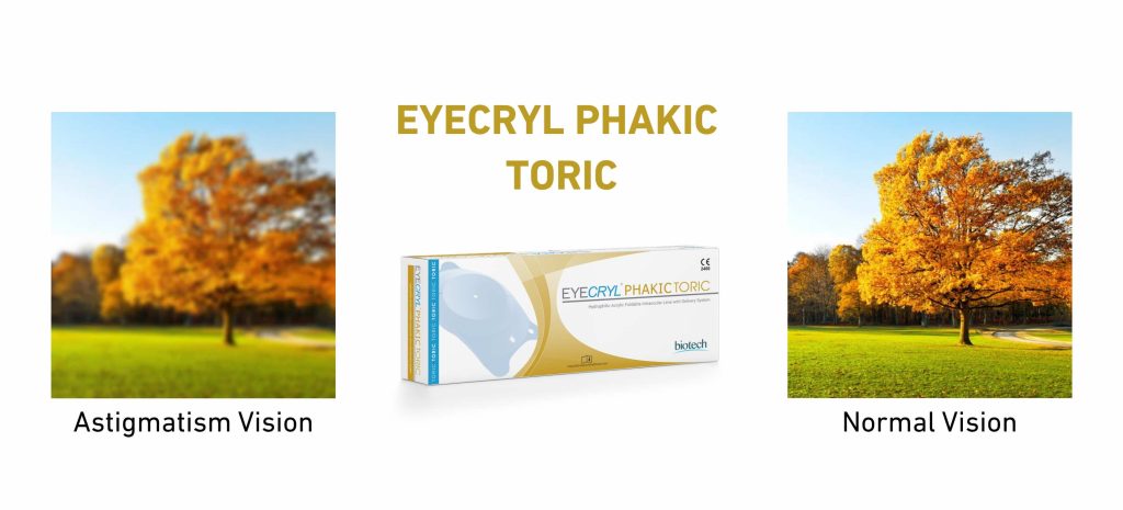 Get Rid of the Shadows Caused by Astigmatism: Toric Phakic Lens Technology